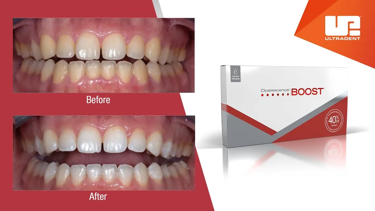 31813 teeth whitening cost wbp