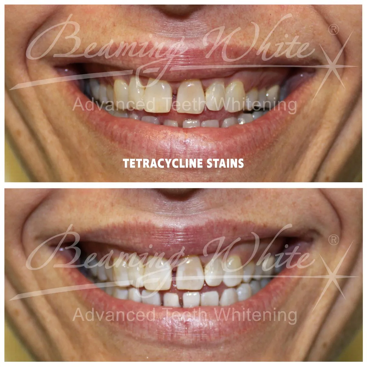 31818 teeth whitening dentist results avoid stains