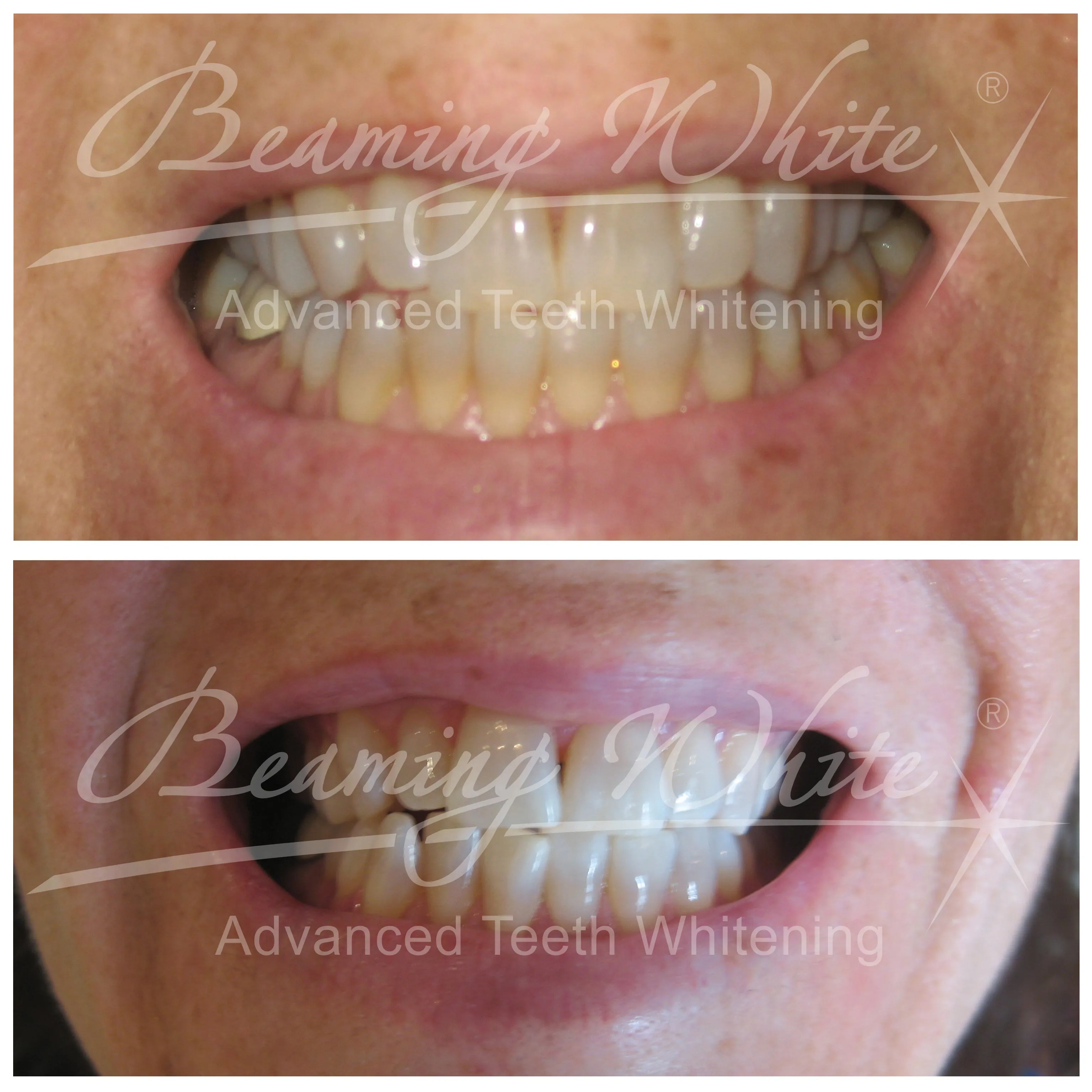31818 teeth whitening dentist results options