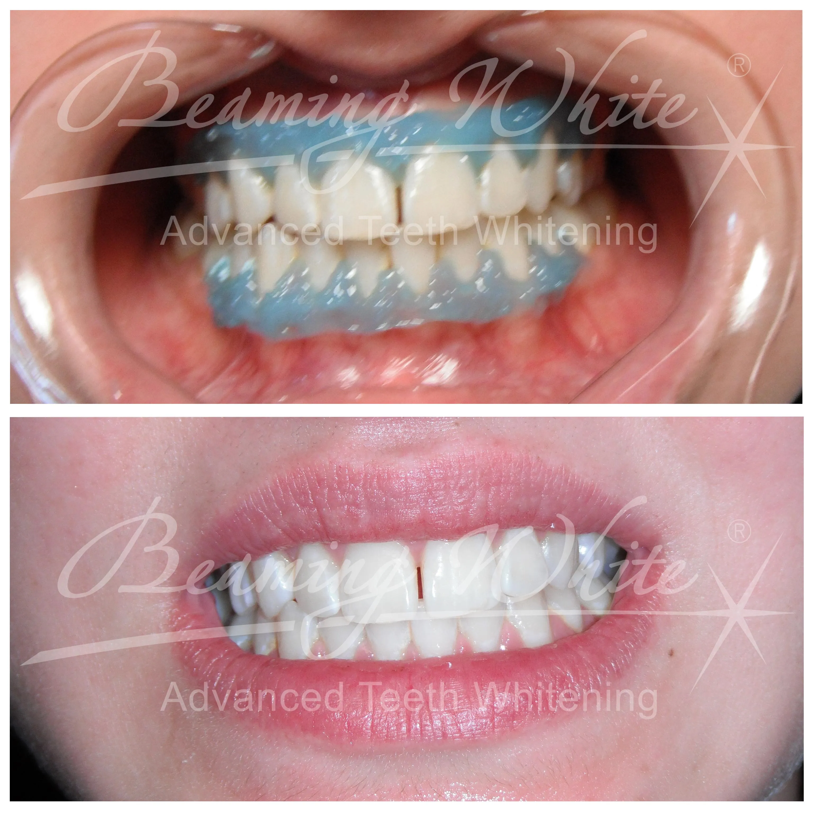 31818 teeth whitening dentist results oral exam