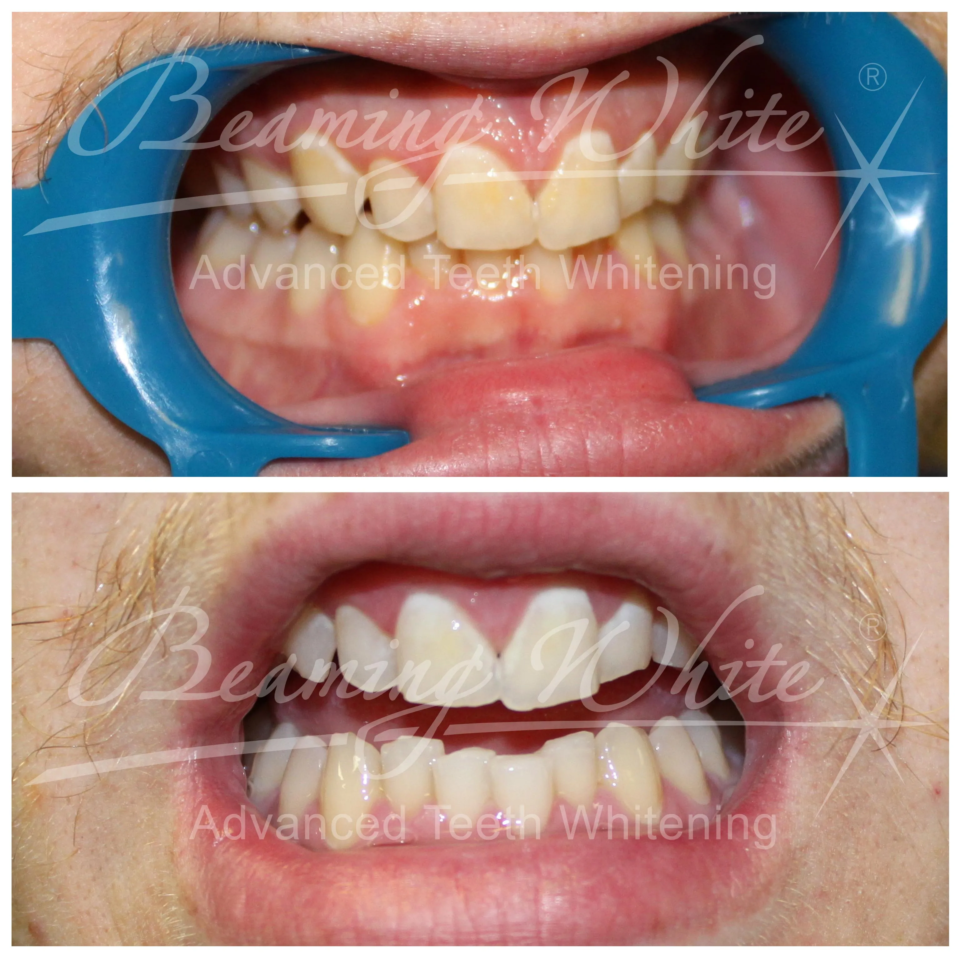 31818 teeth whitening dentist results procedure