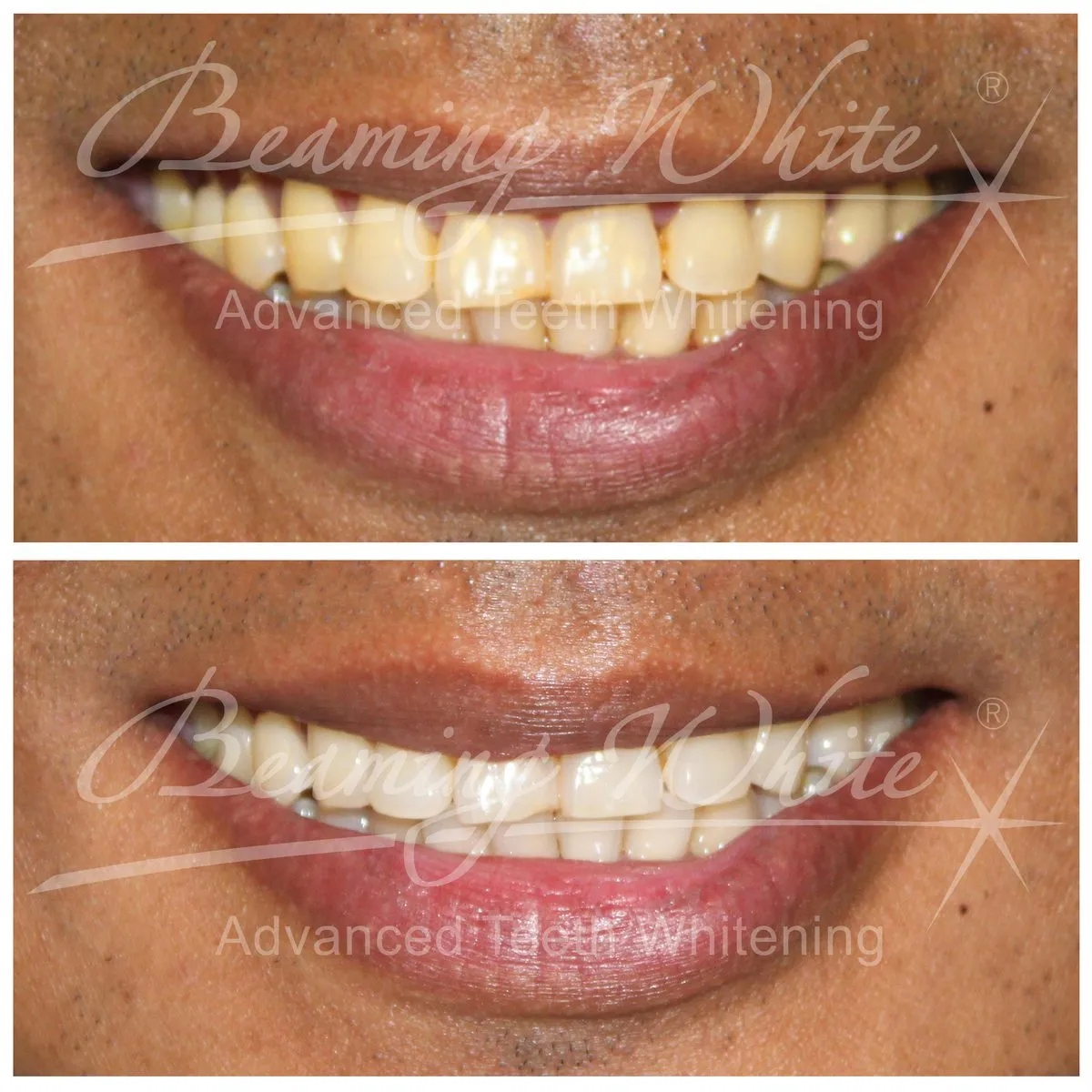 /img/31818-teeth-whitening-dentist-results-smile.webp