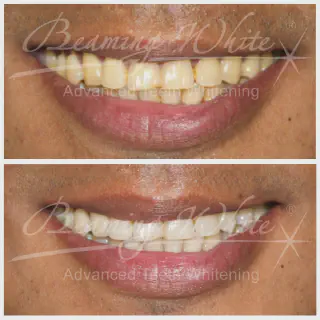 /img/31818-teeth-whitening-dentist-results-smile.webp
