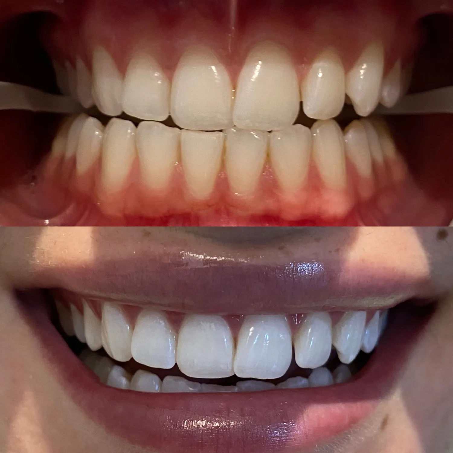 31820 teeth whitening northern beaches overview