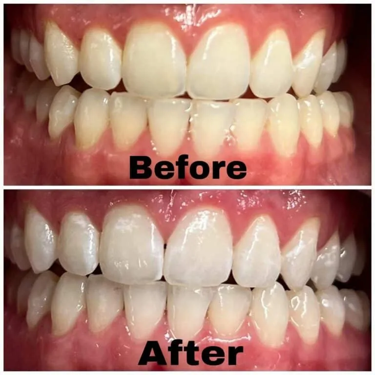 31821 in office teeth whitening
