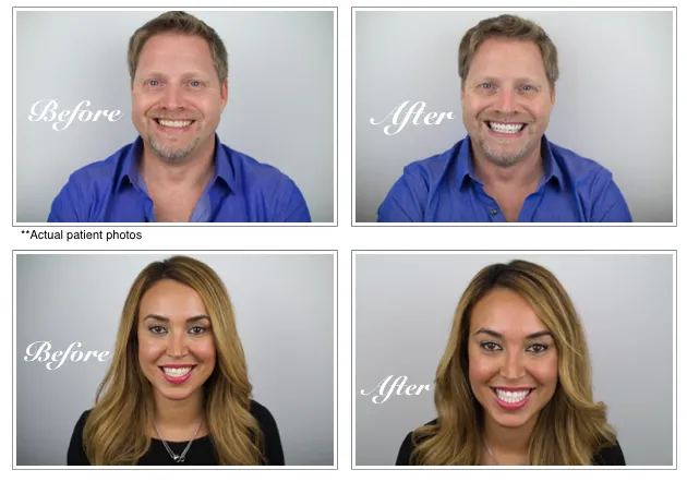 31821 tooth discoloration causes