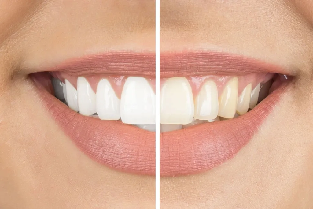 31824 teeth whitening bayside 2