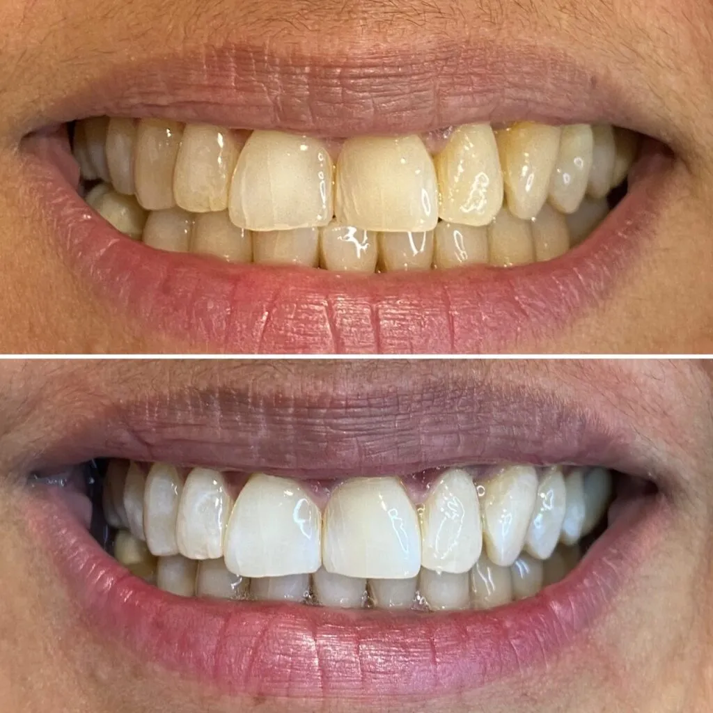 31824 teeth whitening bayside 4