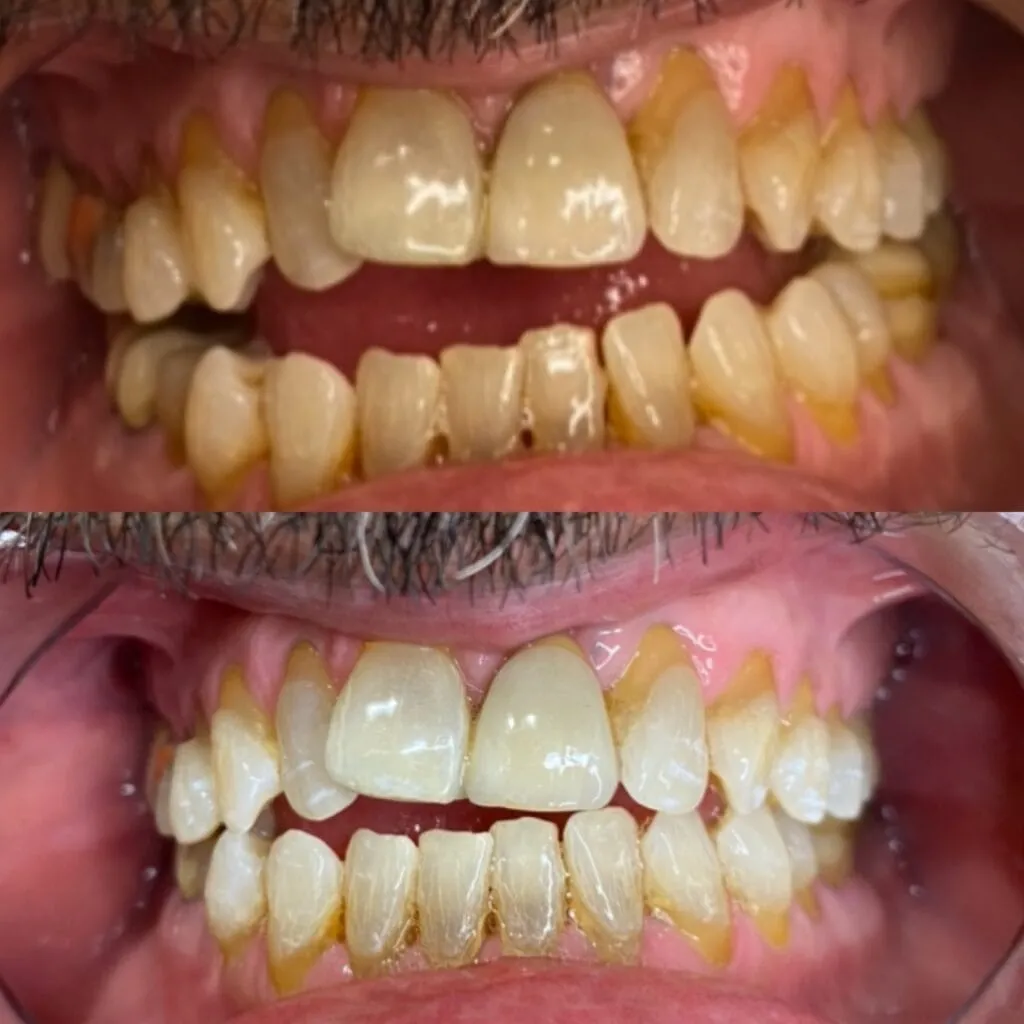 31824 teeth whitening bayside 5