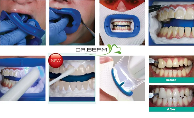 31829 zoom whitening singapore before after