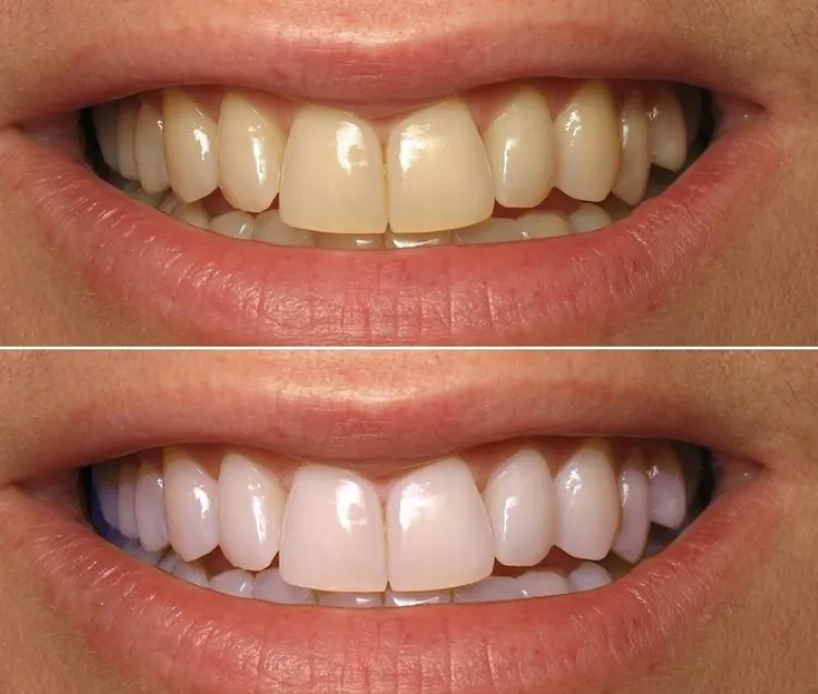 31831 teeth whitening strips sensitivity