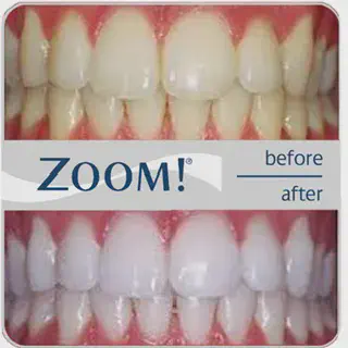 /img/31832-zoom-whitening-patient.webp