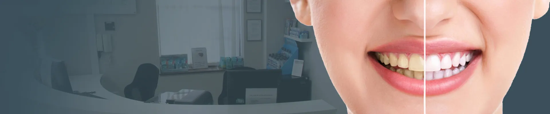 31833 in office teeth whitening