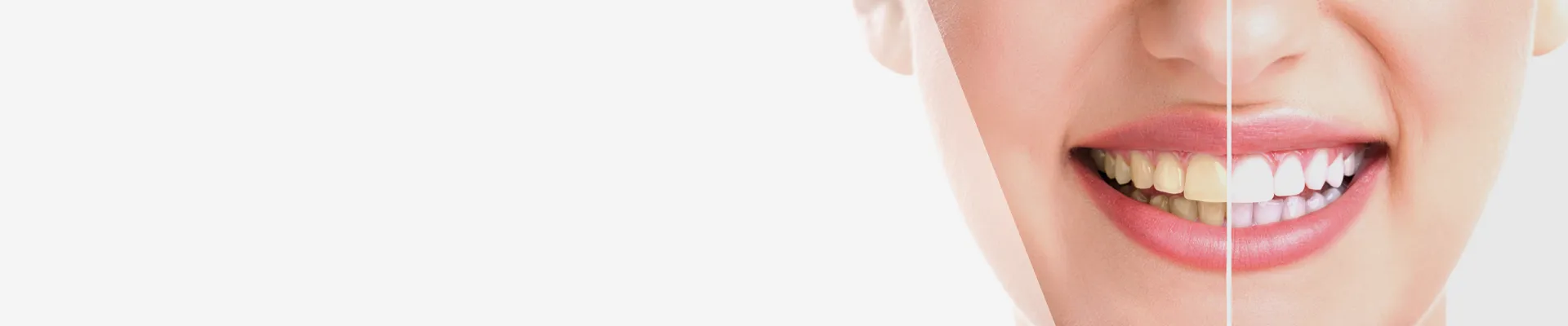 31833 teeth whitening maidstone overview