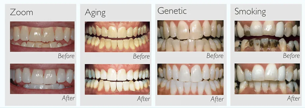 31833 teeth whitening process