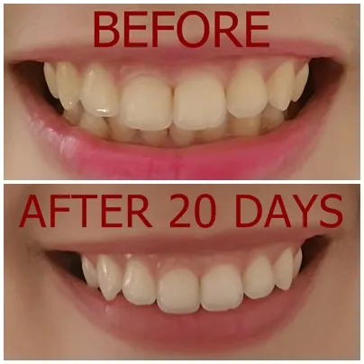 /img/31836-teeth-whitening-results.webp