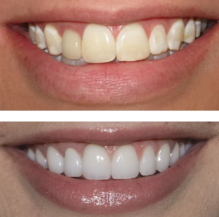 31838 professional whitening
