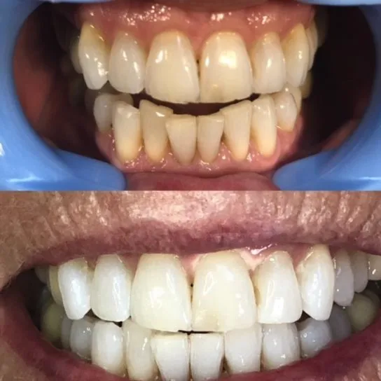 31843 custom tray whitening