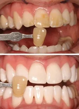 31844 teeth whitening jackson ms image3