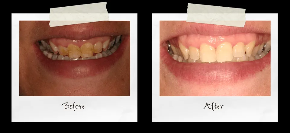 31851 teeth whitening aftercare