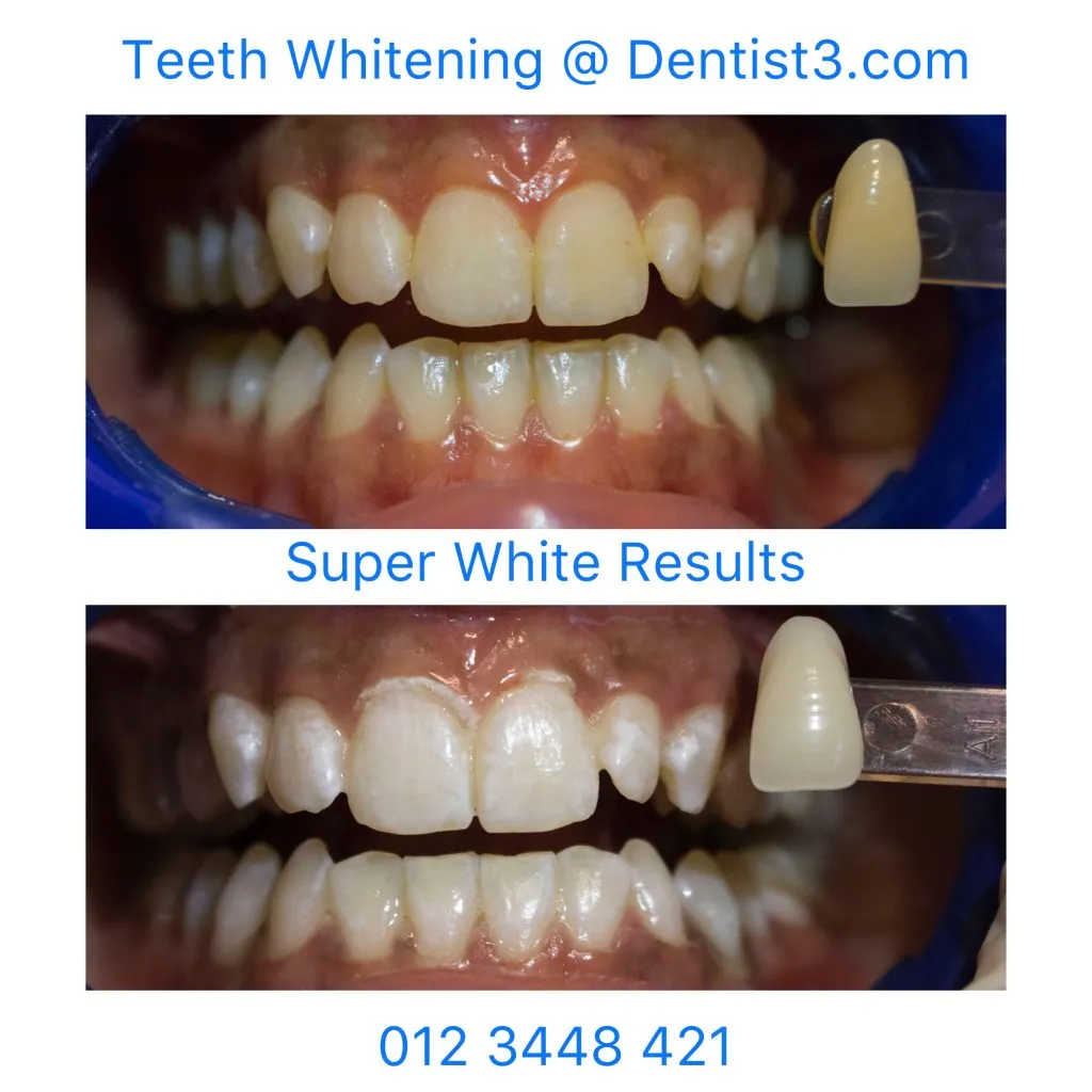 31852 teeth whitening procedures
