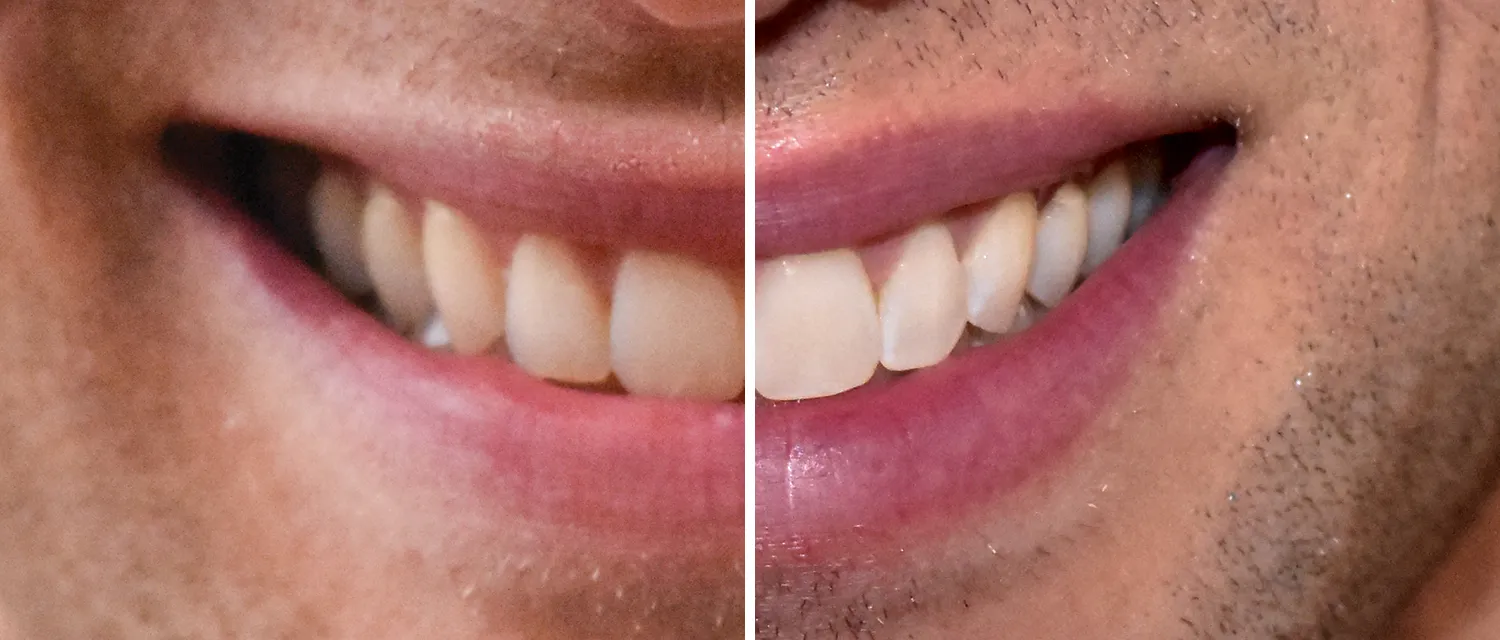 31853 alternative teeth whitening