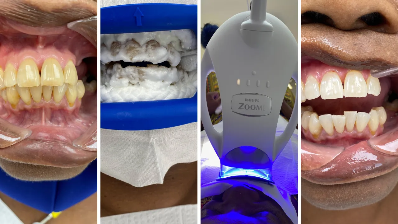31853 teeth whitening ingredients