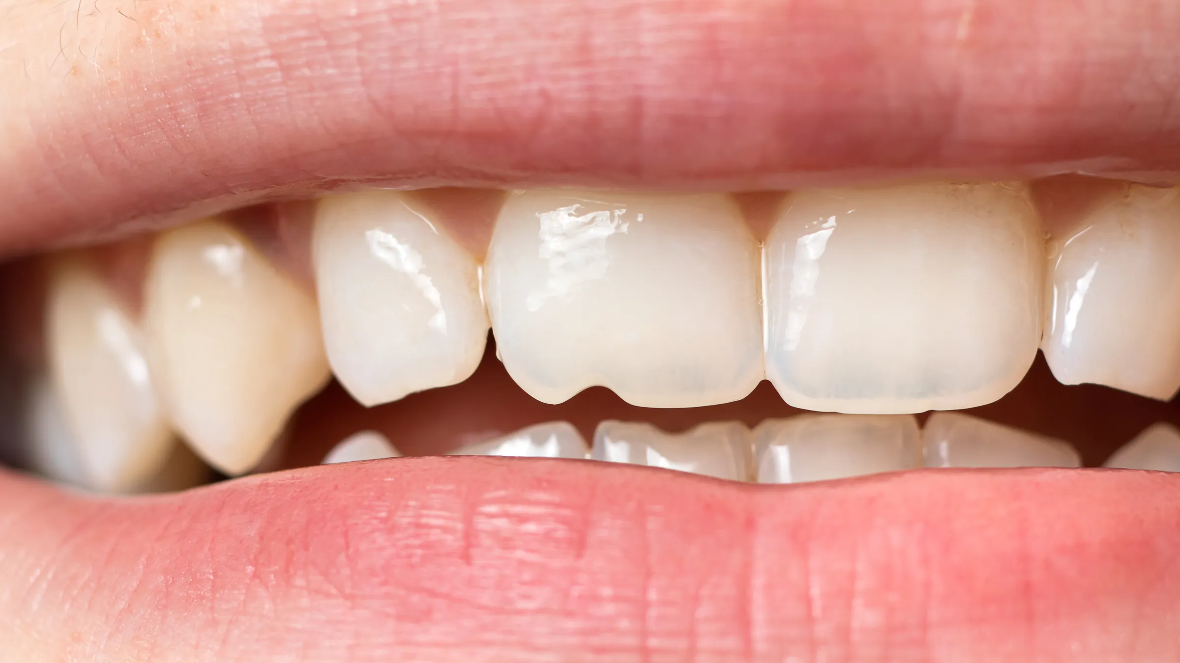 /img/31860-teeth-whitening-avoid-8.webp