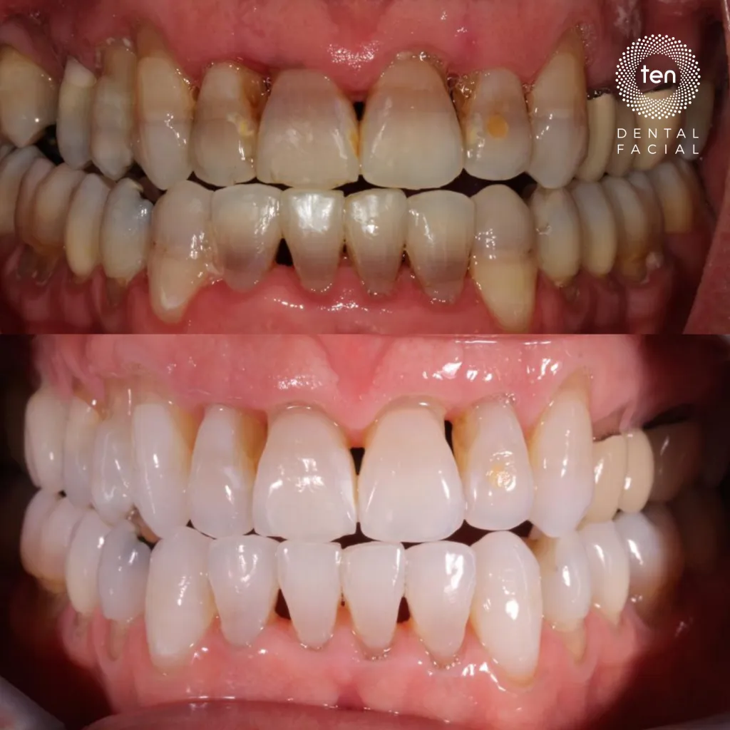 31860 teeth whitening methods 6
