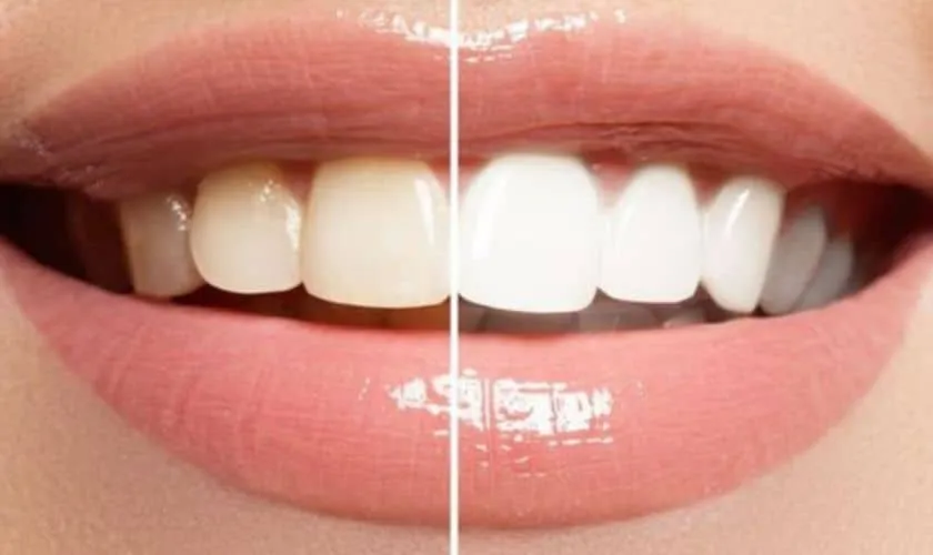 31860 teeth whitening products 4