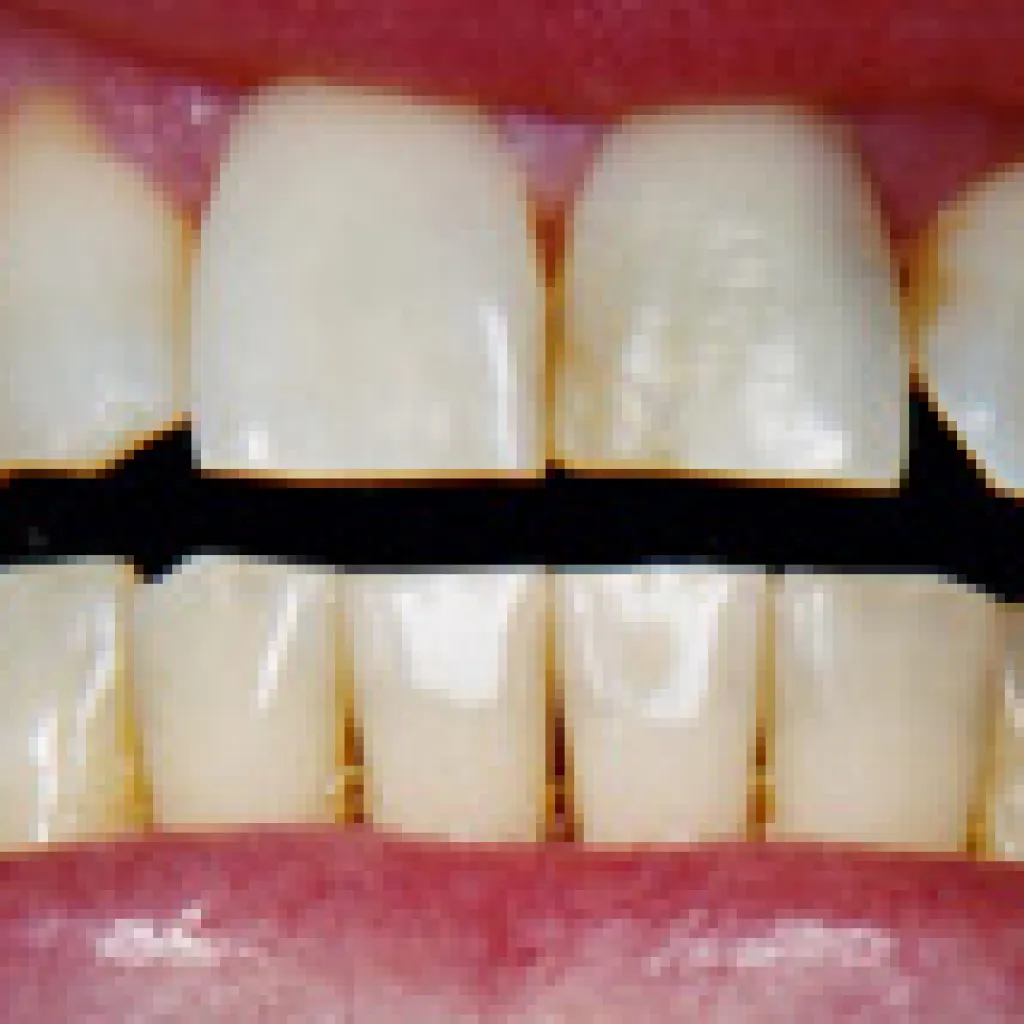 31871 fluoride treatment