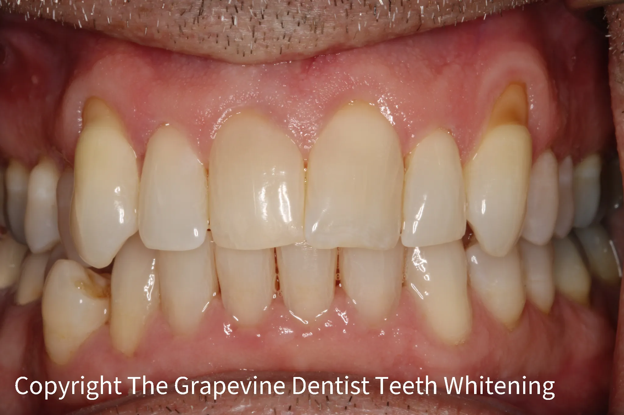 31871 teeth whitening sensitivity