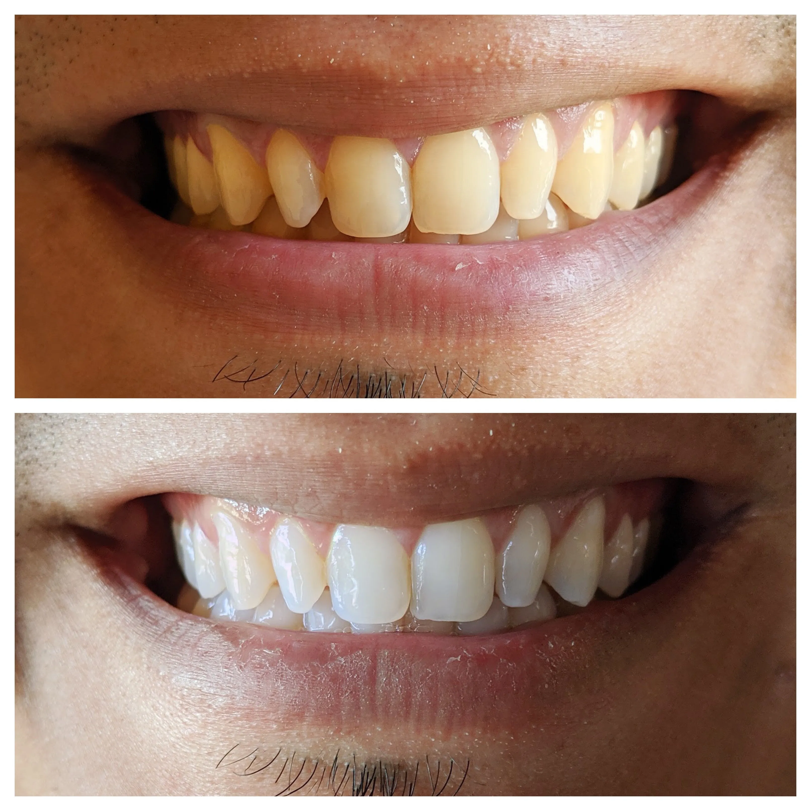 31873 colgate whitening strips usa image3