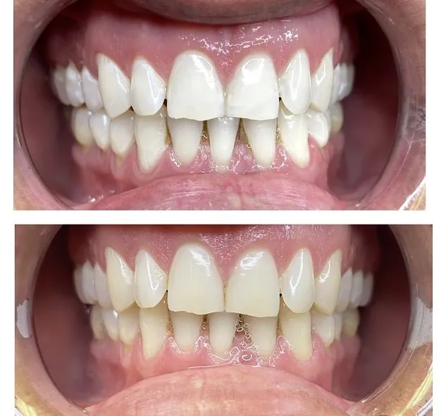 31874 at home teeth whitening portland me