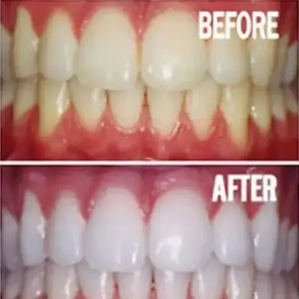 31874 in office teeth whitening portland me