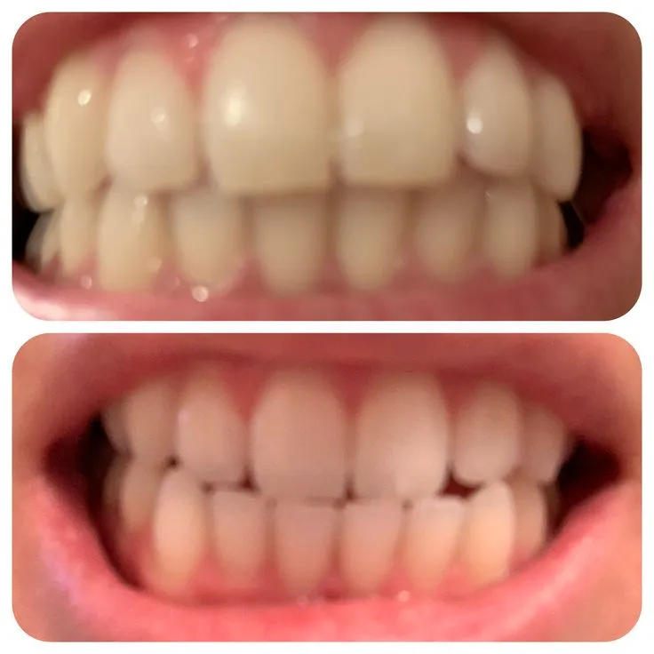 31879 hydrogen peroxide teeth