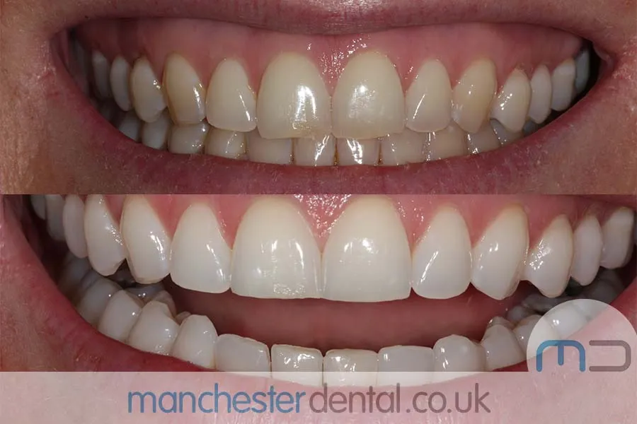 31880 teeth whitening buckinghamshire anti aging