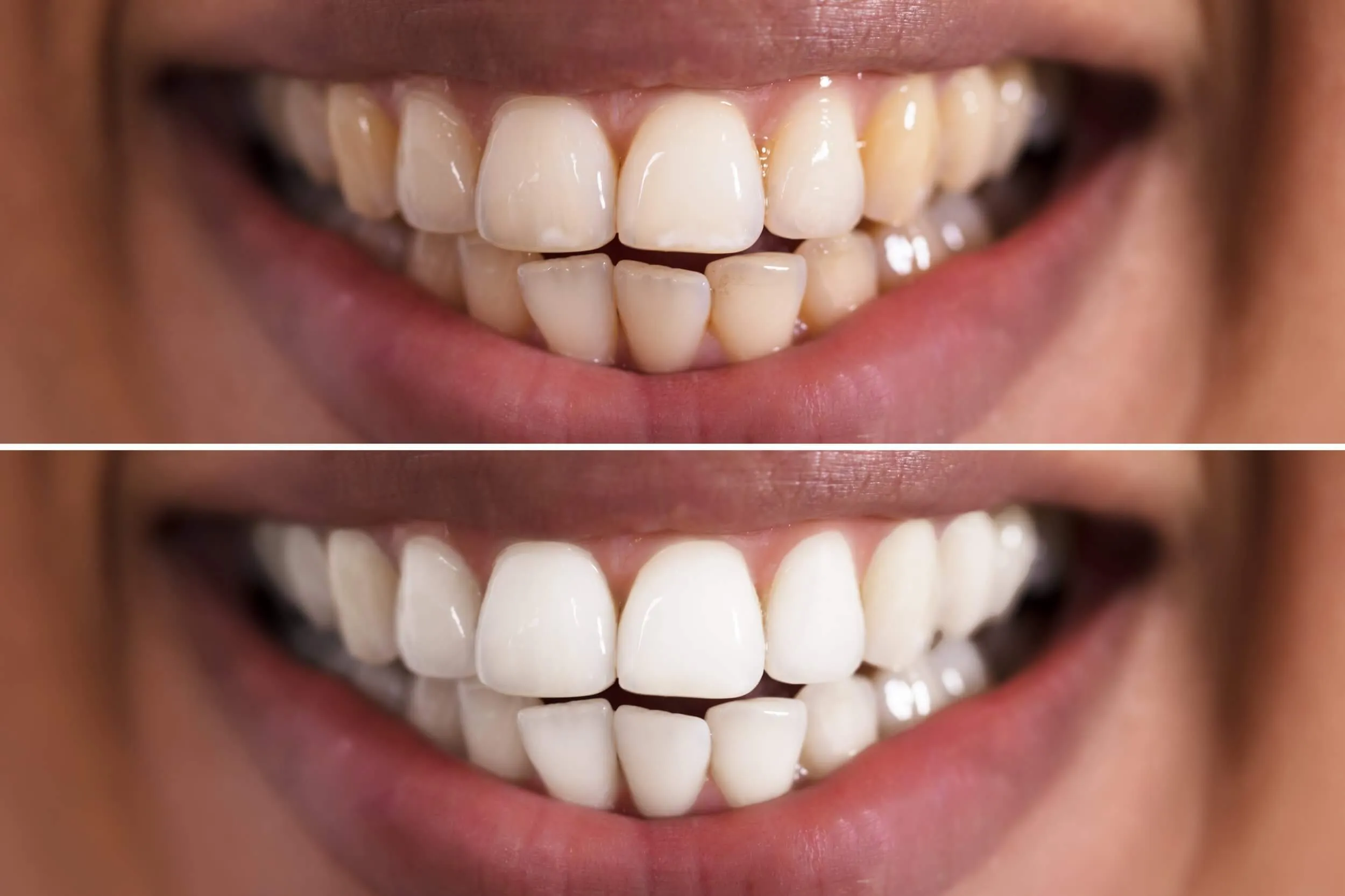 31880 teeth whitening buckinghamshire oral hygiene