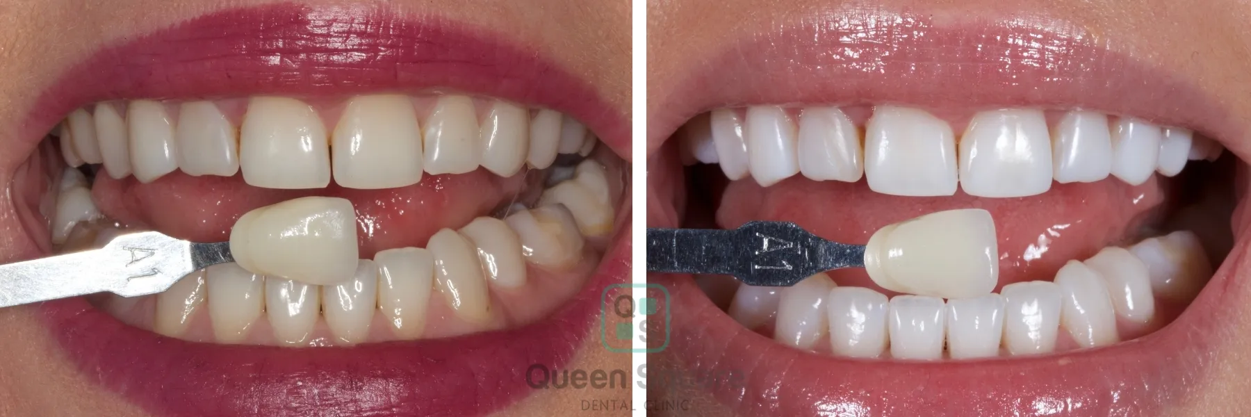 /img/31880-teeth-whitening-buckinghamshire-results.webp