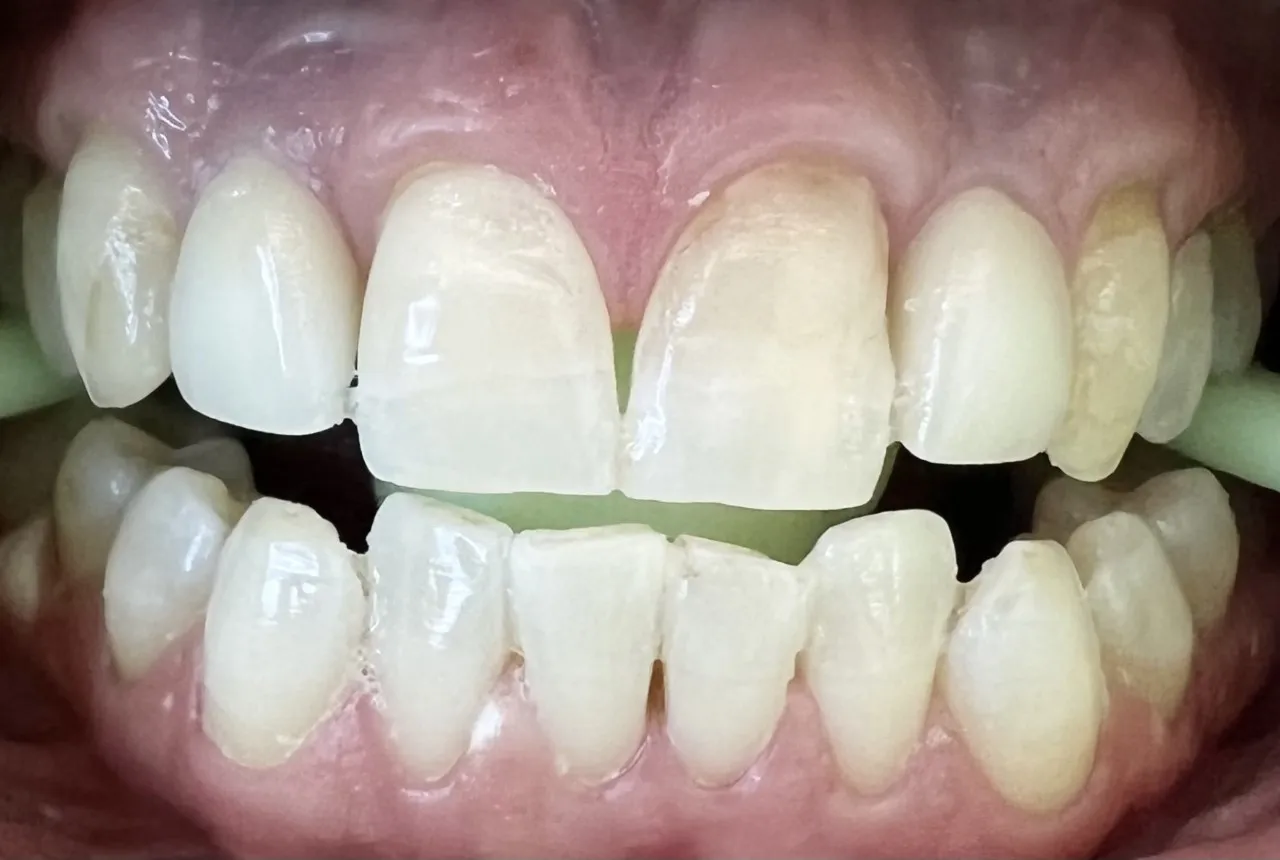 31881 polished teeth whitening results