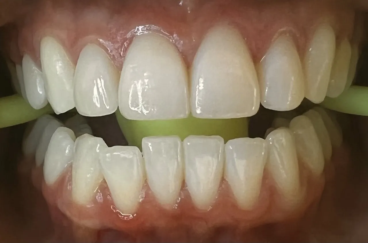 31881 teeth whitening process