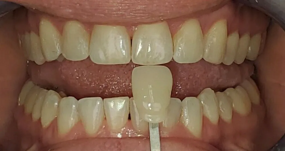 31882 at home whitening kits