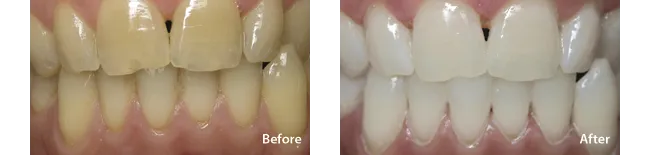 31890 teeth staining causes