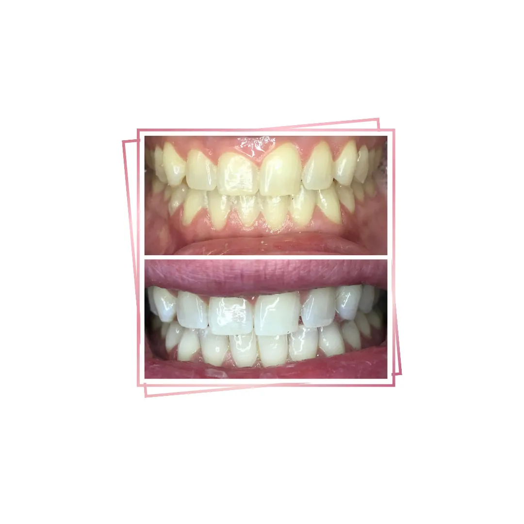 31892 teeth whitening application