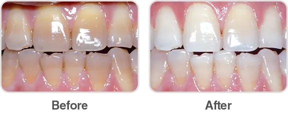 31892 teeth whitening results