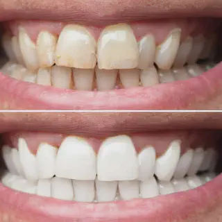 /img/31898-teeth-whitening-products.webp