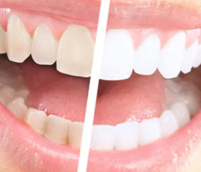 31902 trill teeth whitening before after