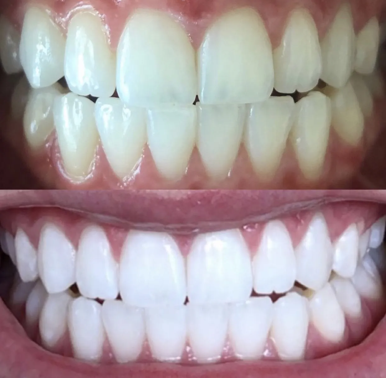 31902 trill teeth whitening guide