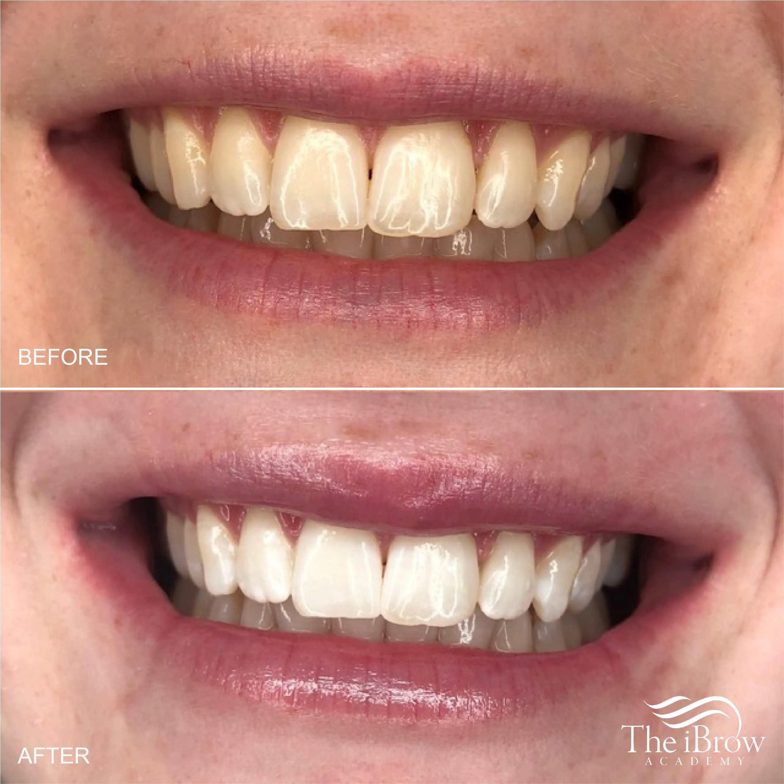 31902 trill teeth whitening results