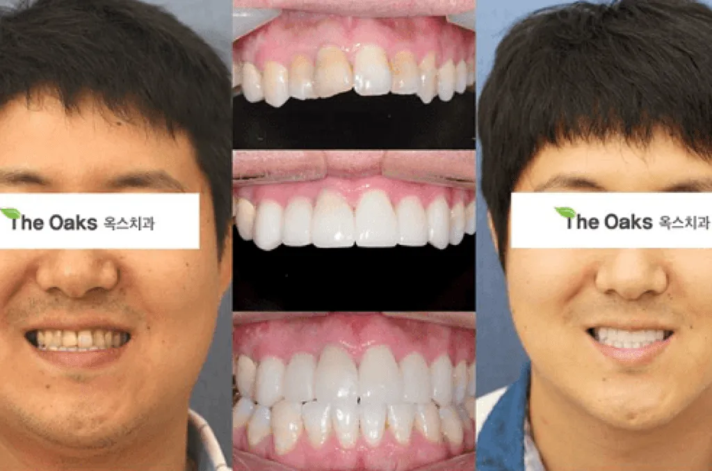 31906 teeth whitening before after